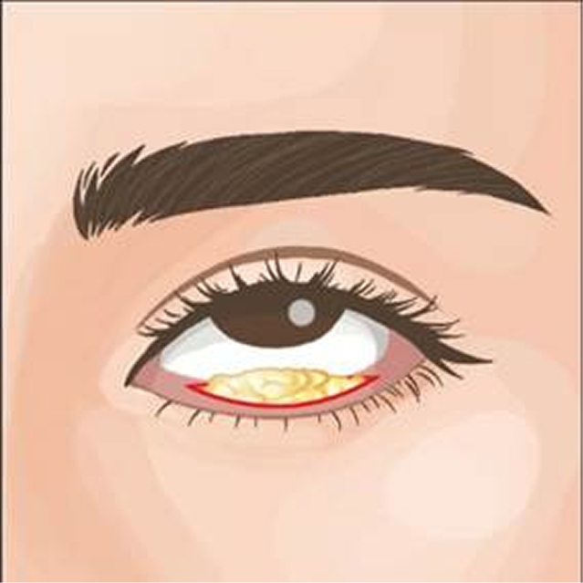 Getting sagging under eyes removed in Hiroshima! Thorough explanation of causes and types of treatment