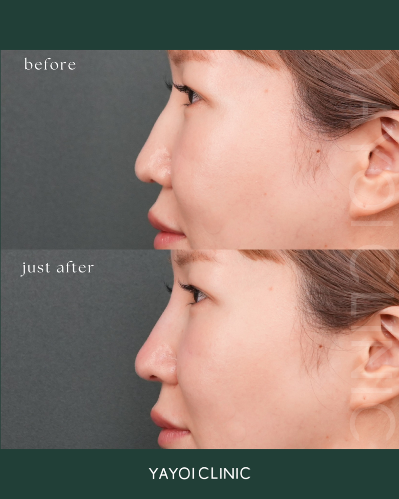 Nasal hyaluronic acid 2.0