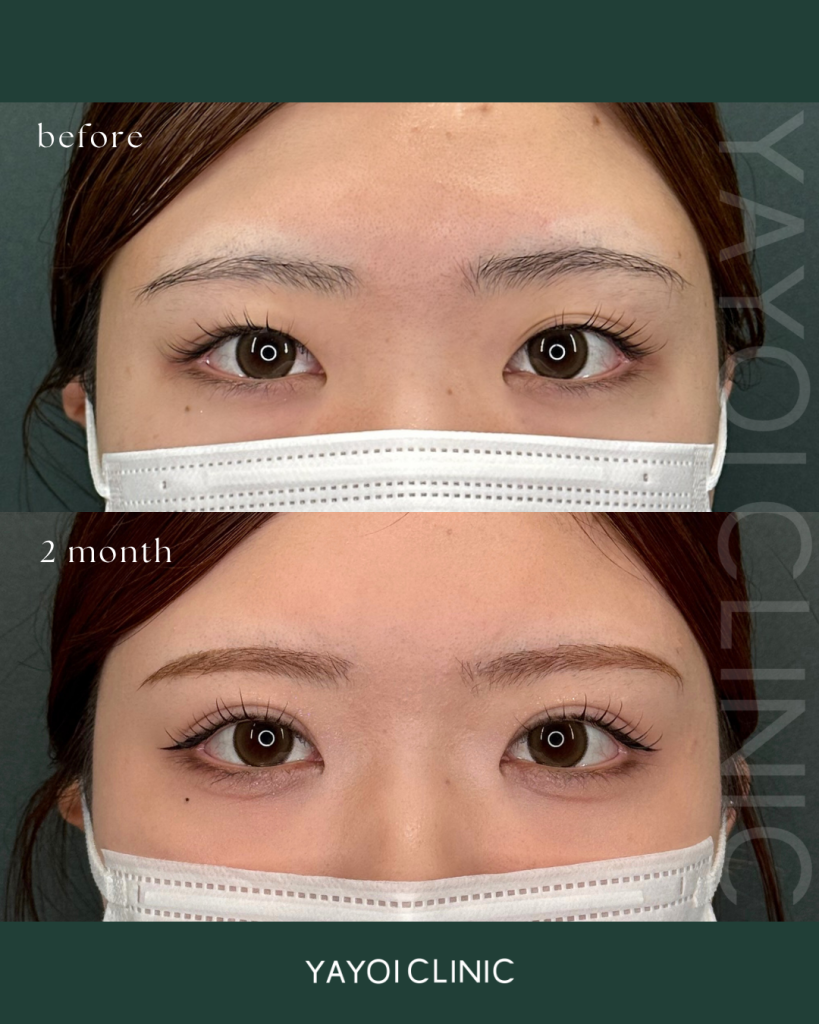 Cosmetic Surgery Double Implantation (4-point clamping)