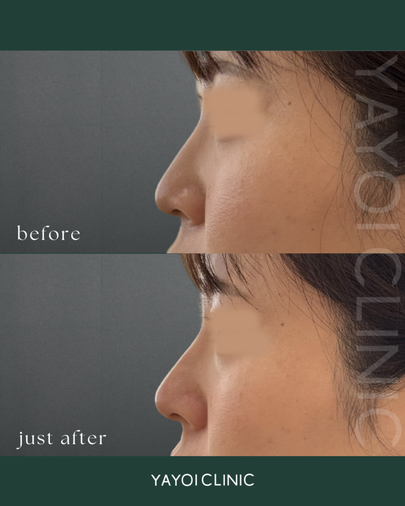 Nasal hyaluronic acid 2.0