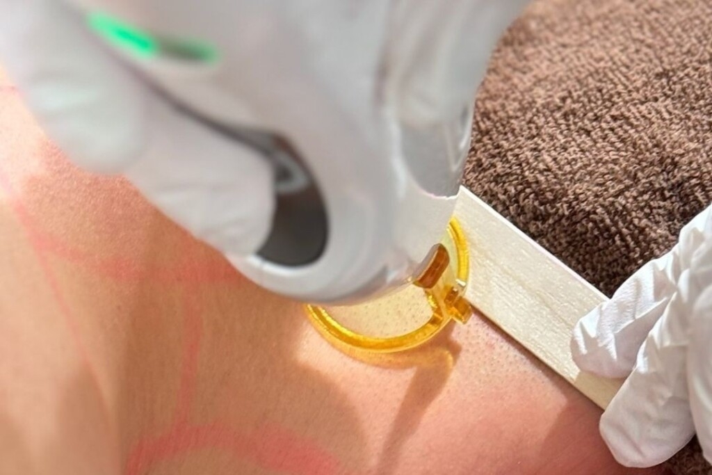 Hiroshima Cosmetic Dermatology approaches men's problems! Explanation of actual conditions and treatment details