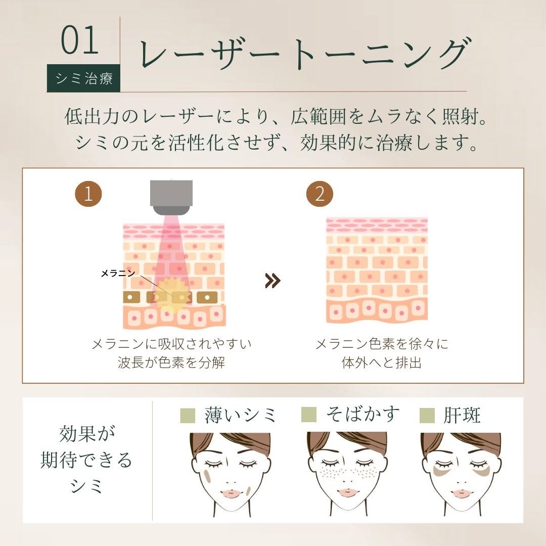 レーザートーニング 