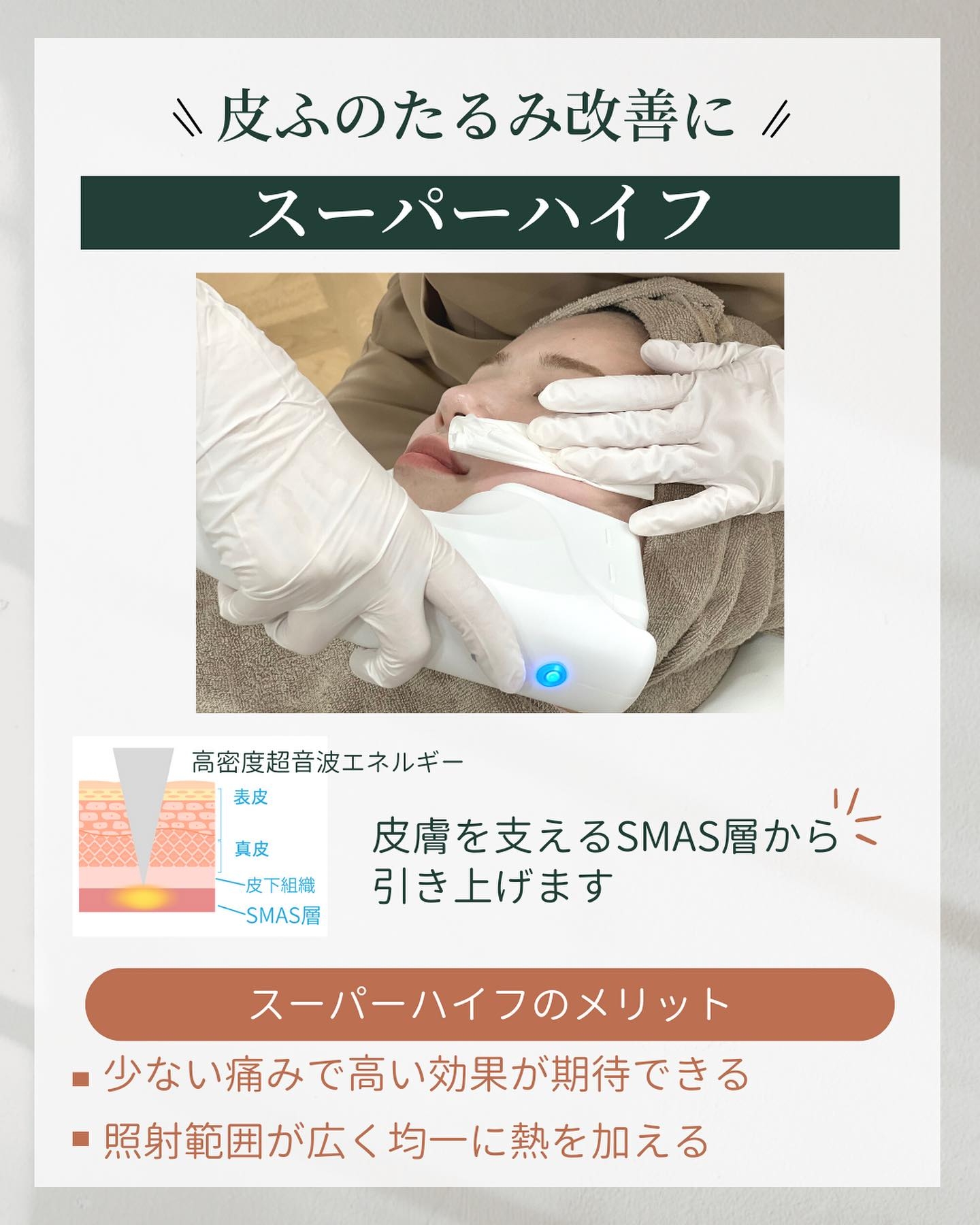 肌の深層（SMAS層）からたるみを引き上げるスーパーハイフによるほうれい線治療