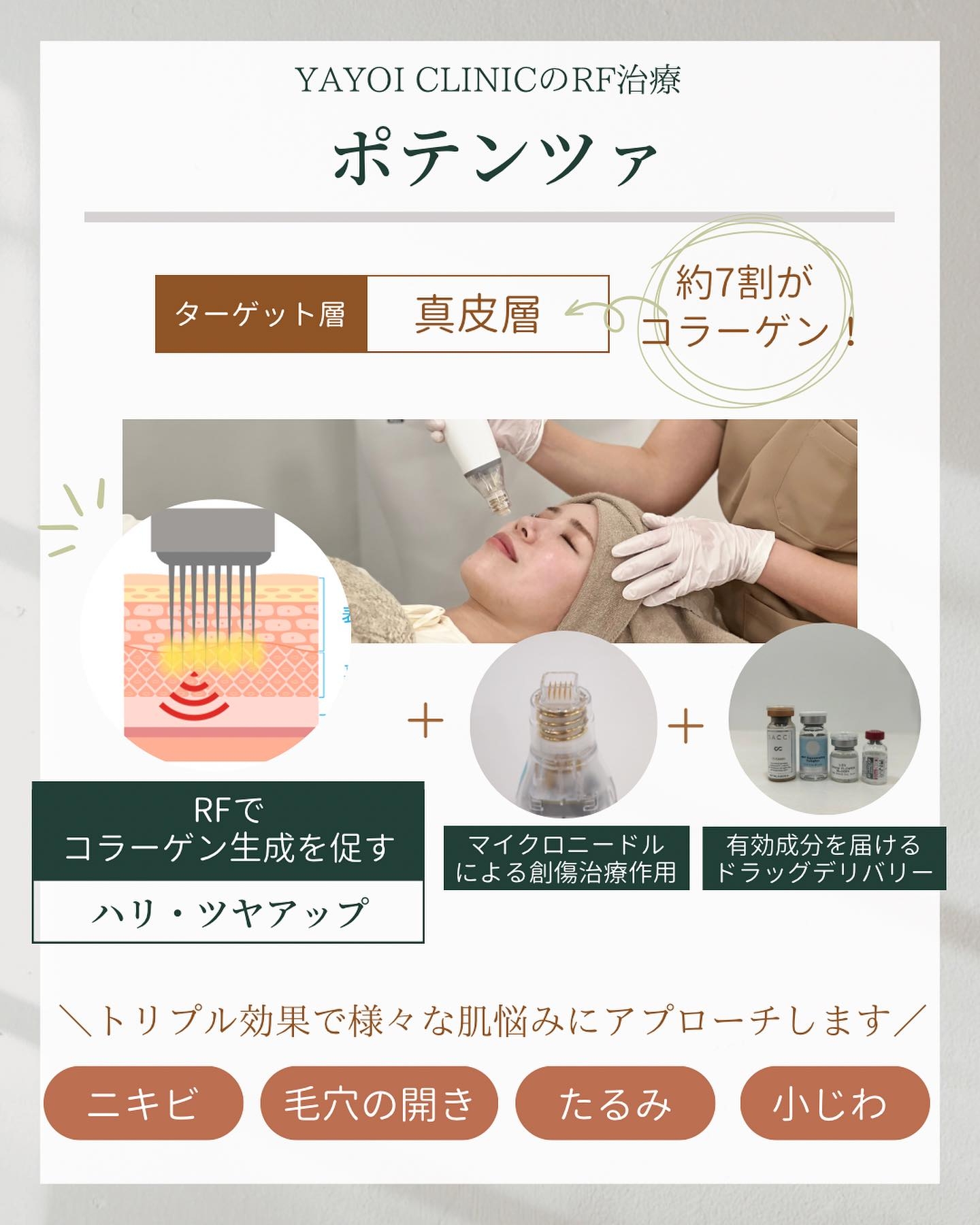 RF治療 ポテンツァ