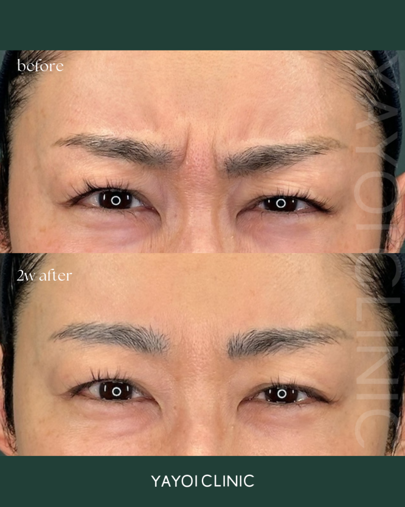 Botox for the eyebrows