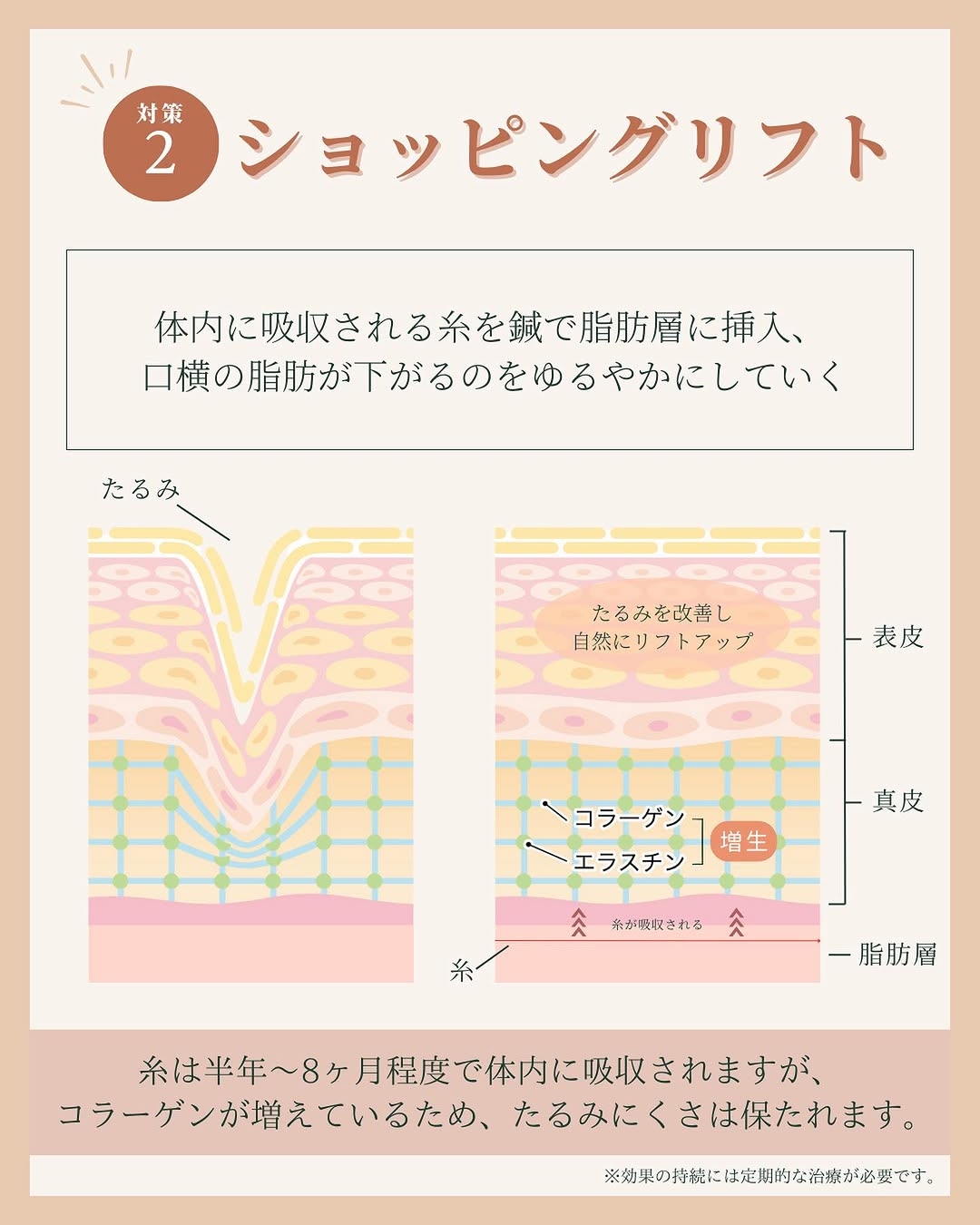ショッピングリフトとは？