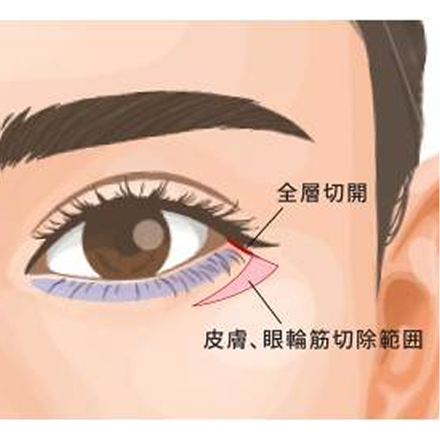 目元形成施術は広島で受けられる?ヤヨイクリニックが施術内容を解説