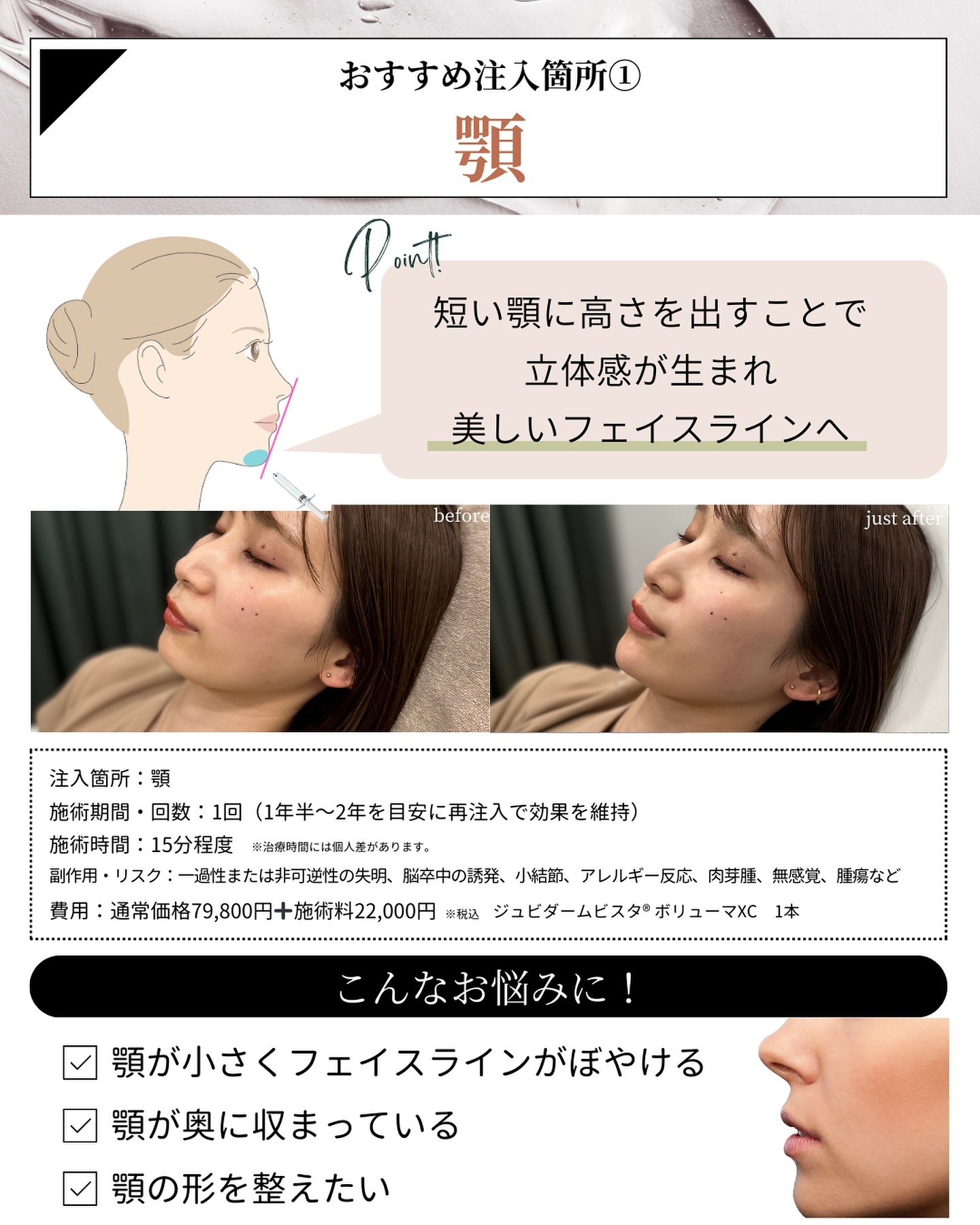 ヒアルロン酸注入　顎