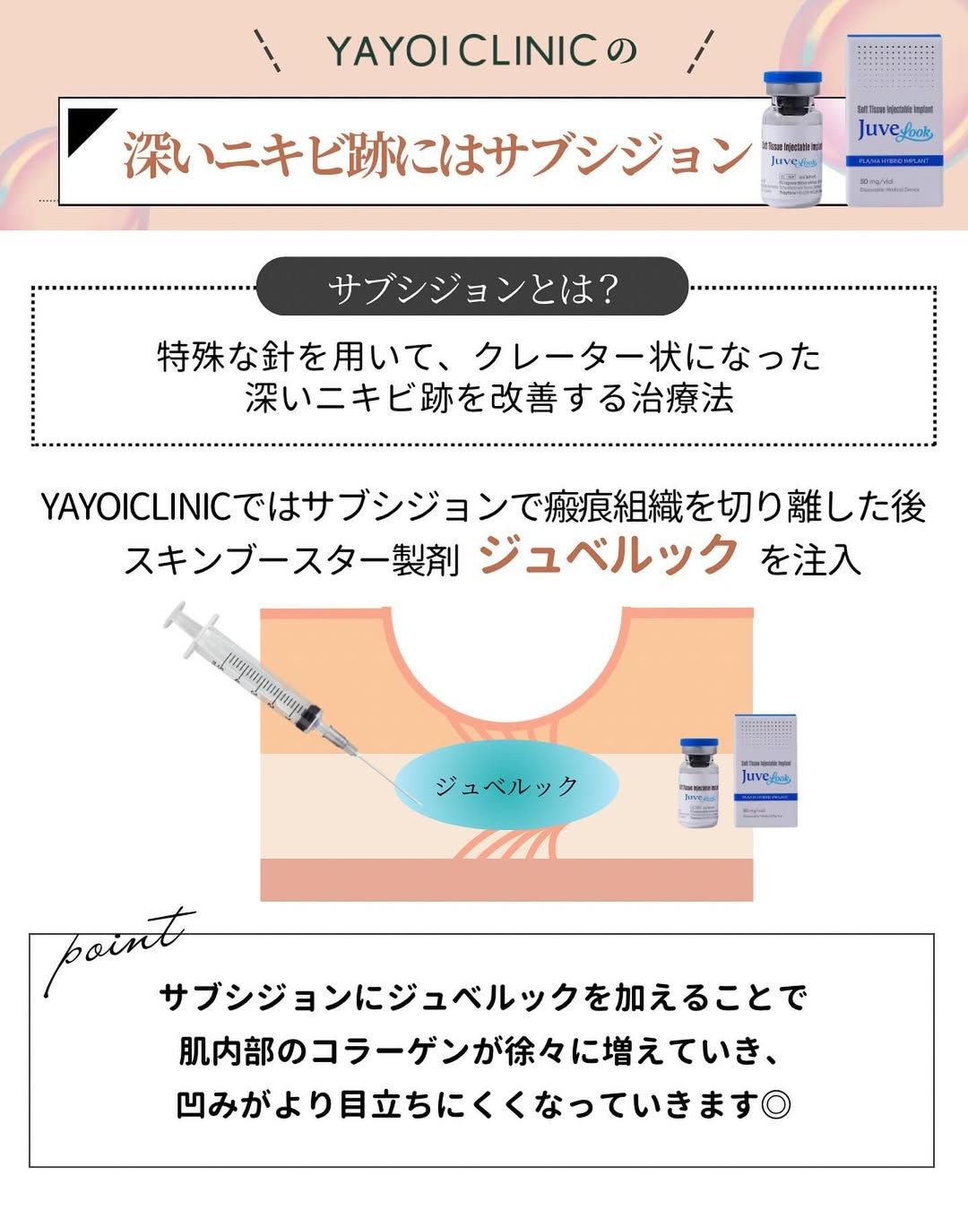 Subcision for deep acne scars