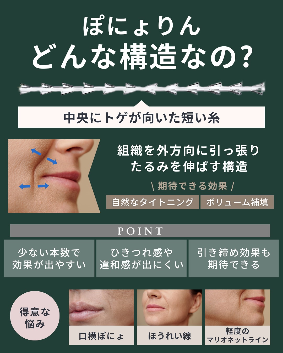 ぽにょりんとはどんな構造なの？