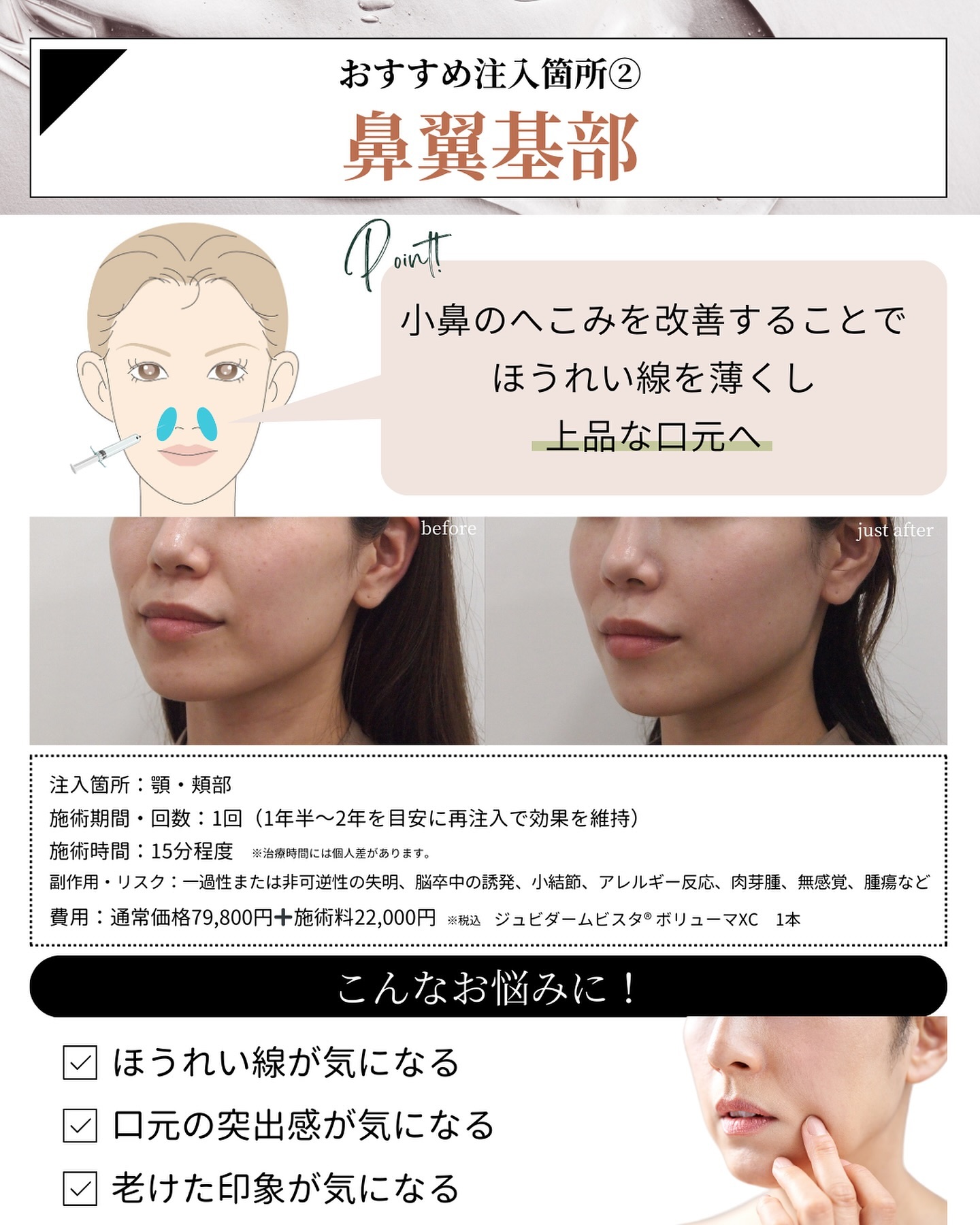 ヒアルロン酸注入　鼻翼基部