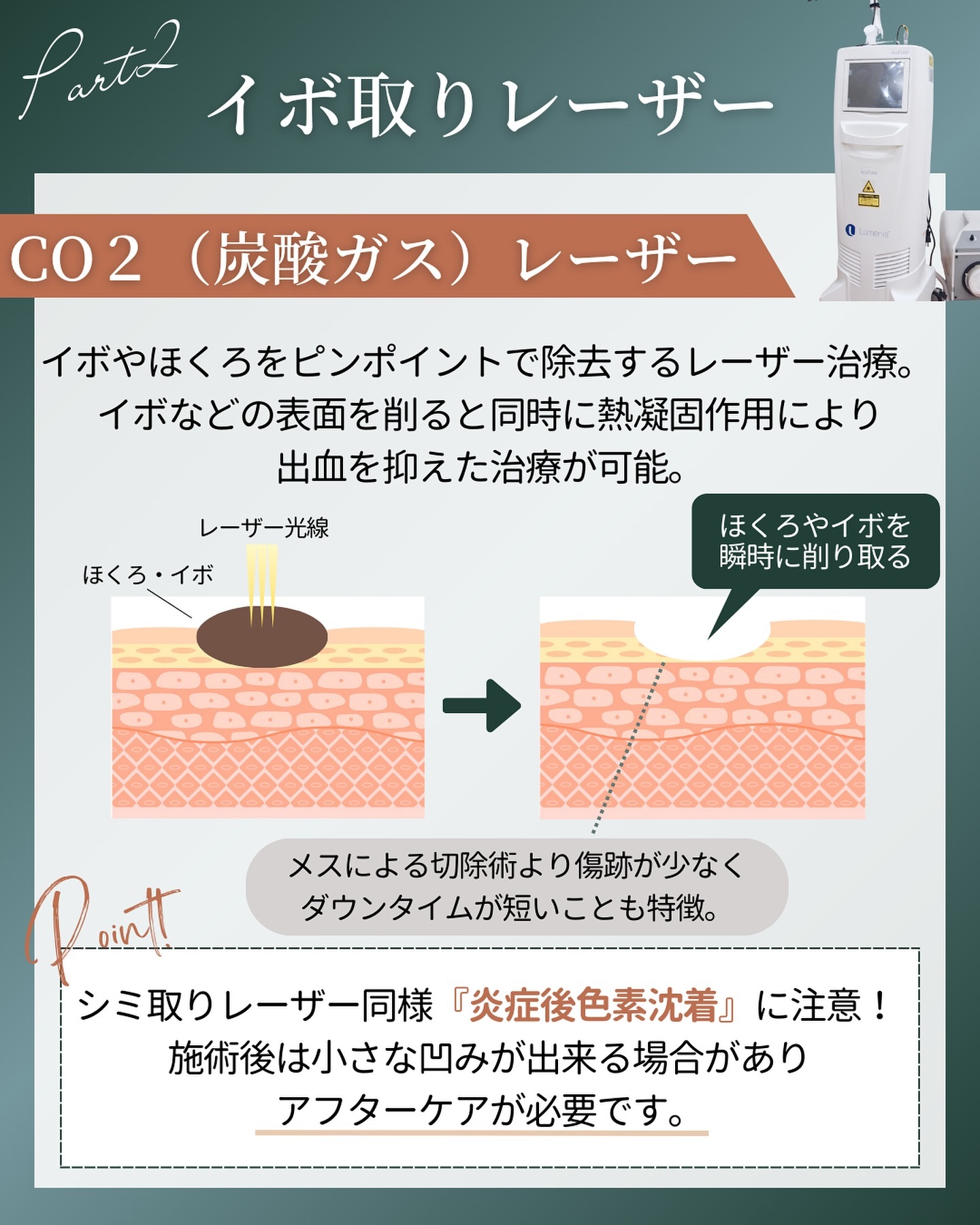 CO2(炭酸ガス)レーザーによるイボ取り