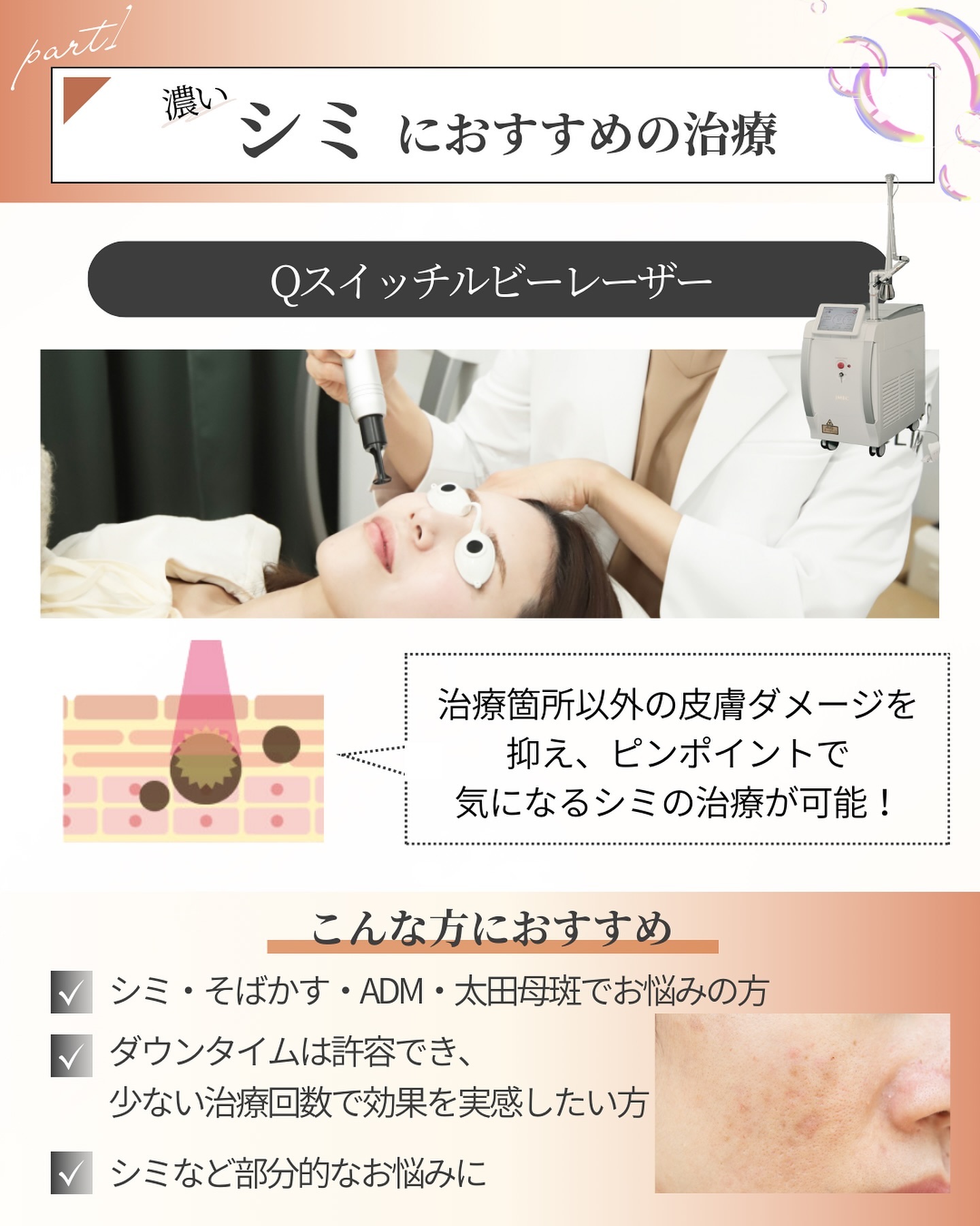 Ｑスイッチルビーレーザーを受ける女性の写真と施術内容