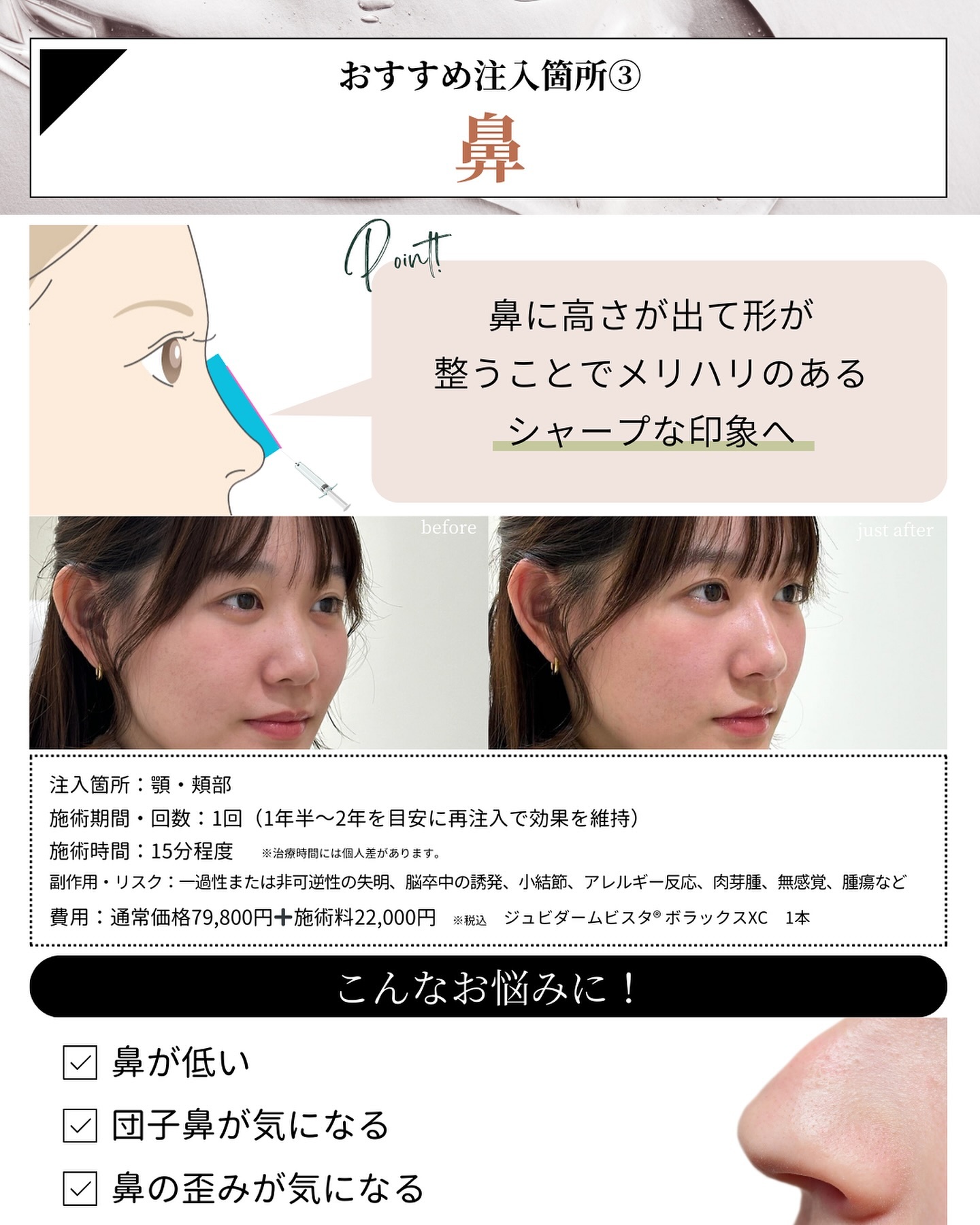 ヒアルロン酸注入　鼻