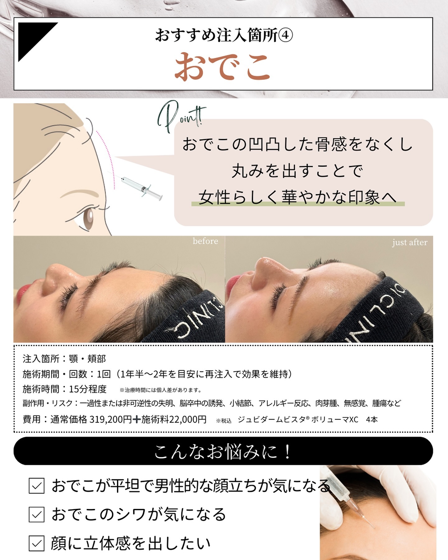 ヒアルロン酸注入　おでこ