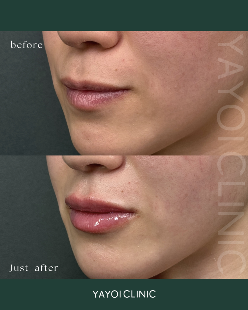 Lip hyaluronic acid