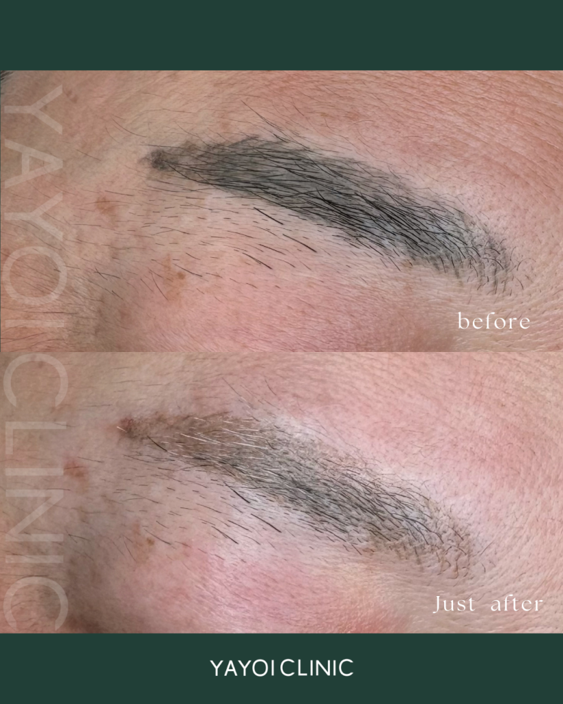 Permanent Makeup Laser Removal (Eyebrows)