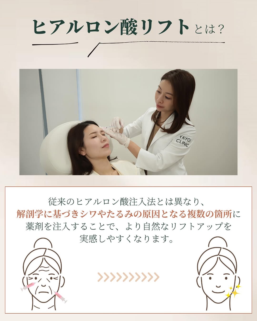 ヒアルロン酸リフトとは？