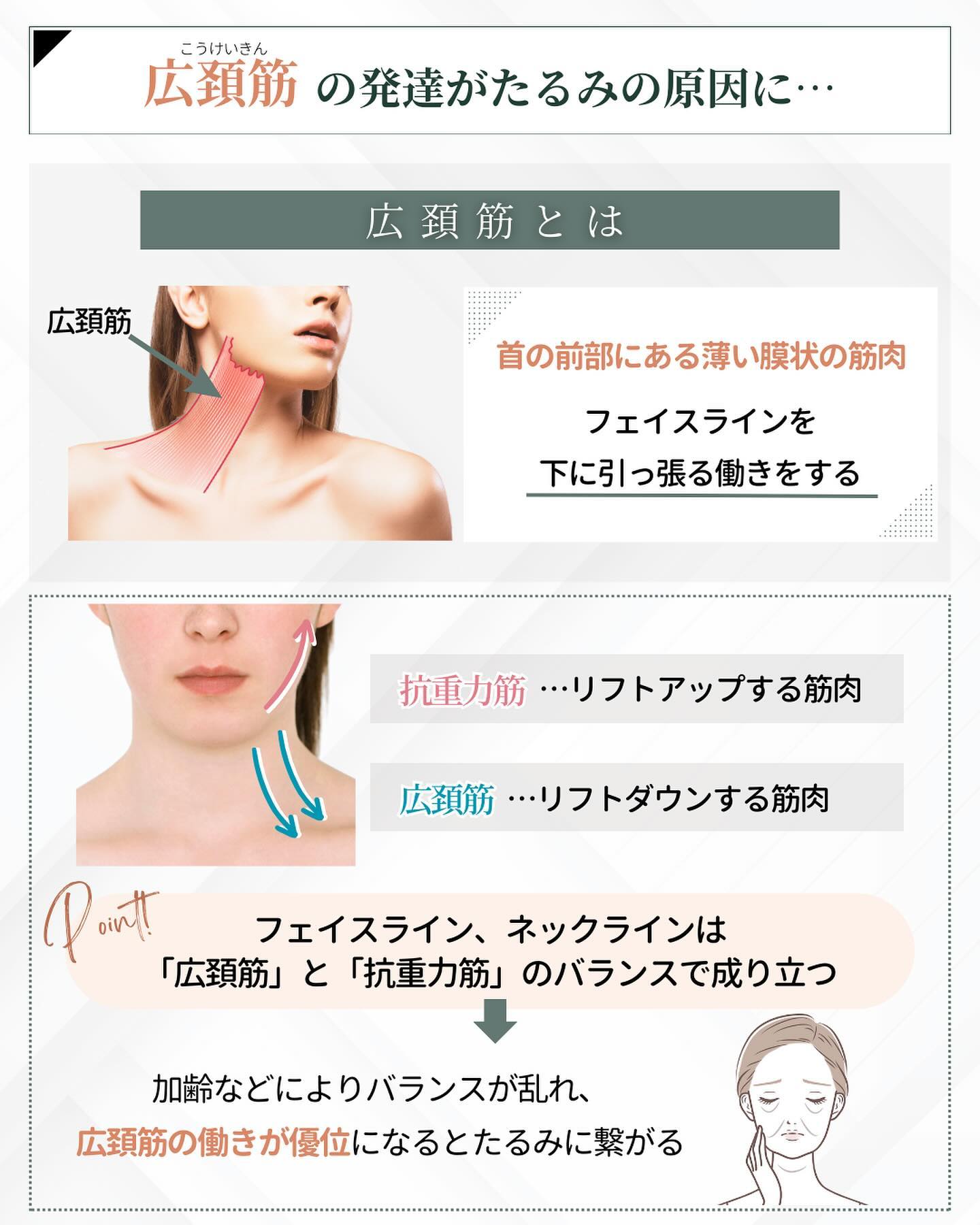 たるみ　原因　広頚筋