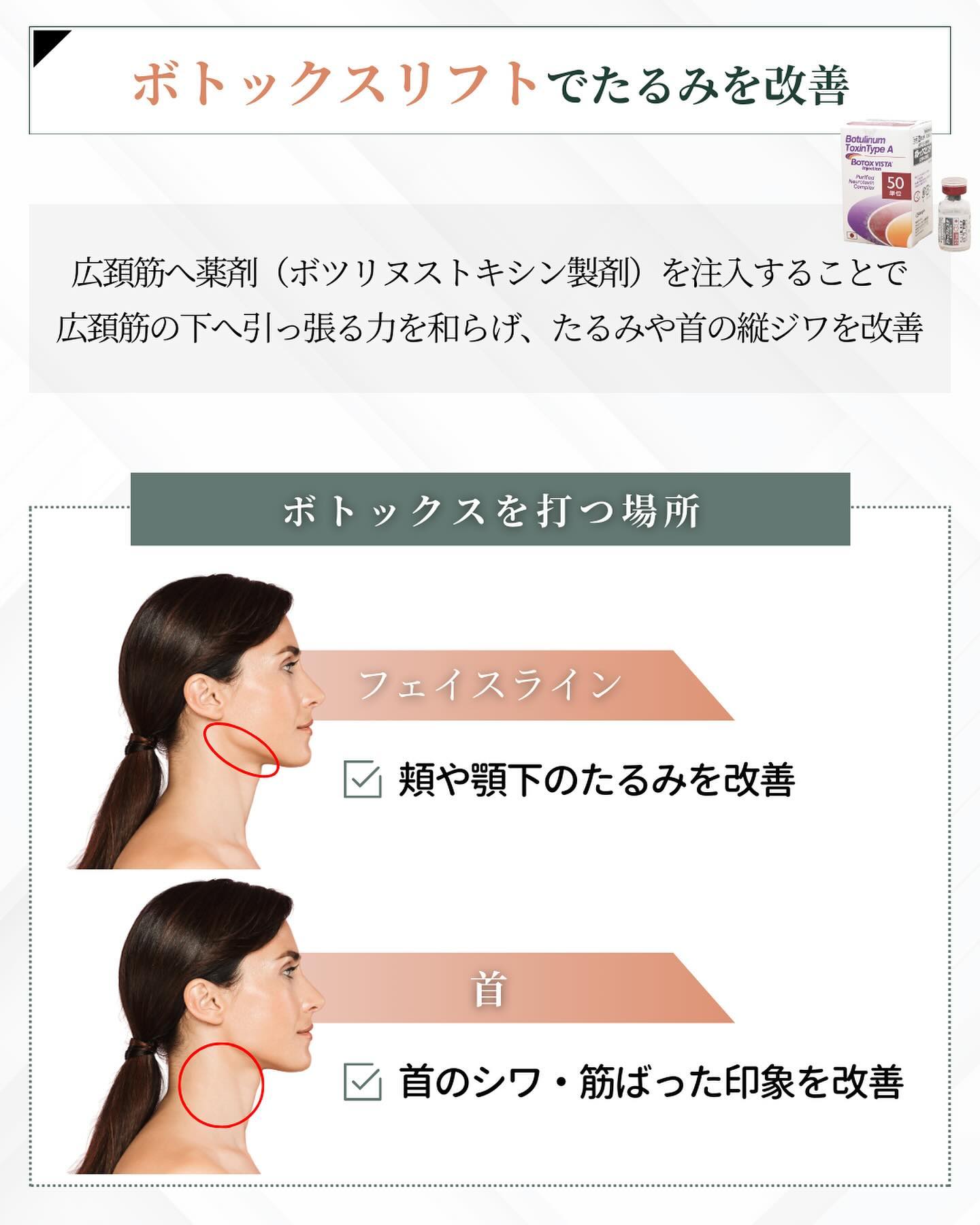 ボトックスリフト　たるみ　改善