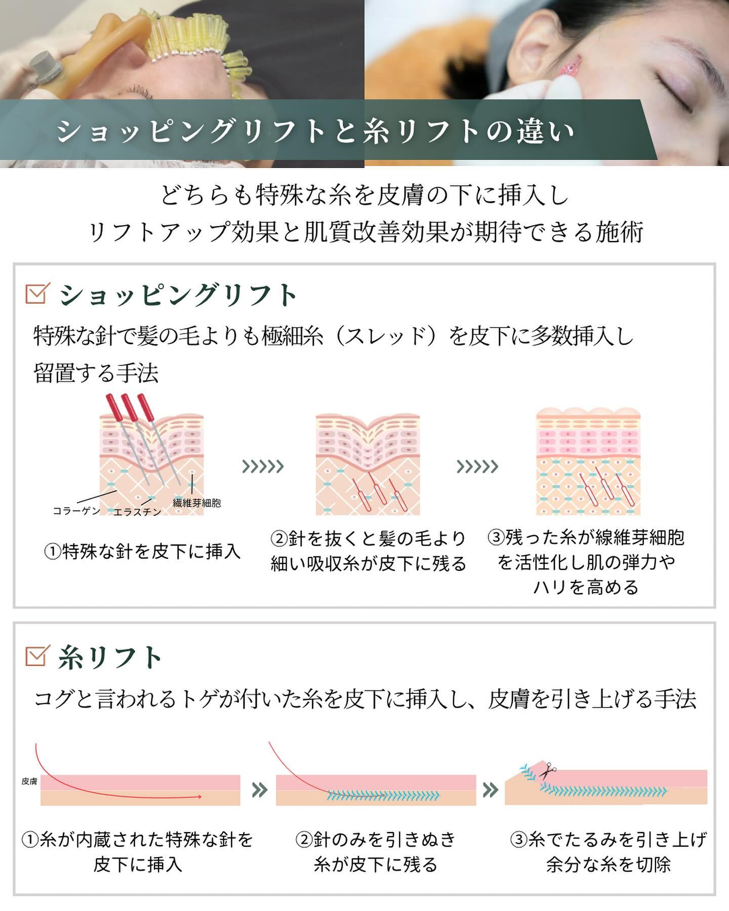 ショッピングリフト　糸リフト　施術内容