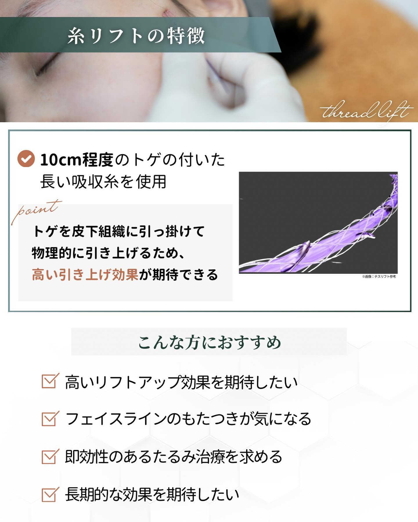糸リフト　特徴