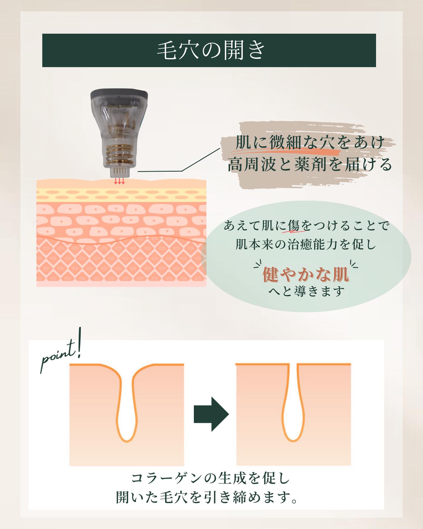 ポテンツァ　毛穴