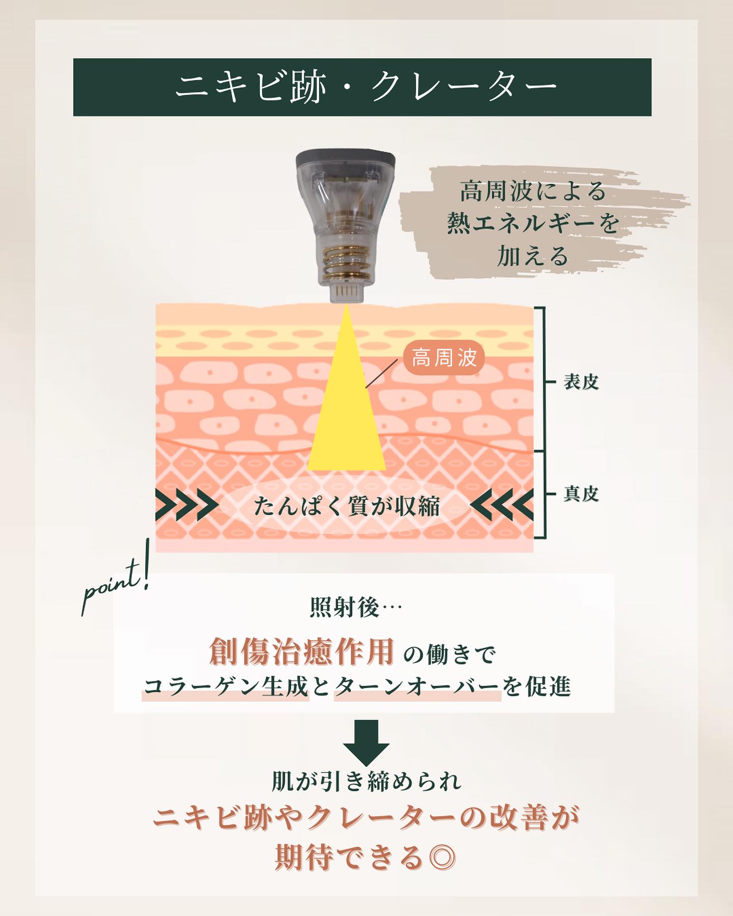 ポテンツァ　ニキビ痕　クレーター