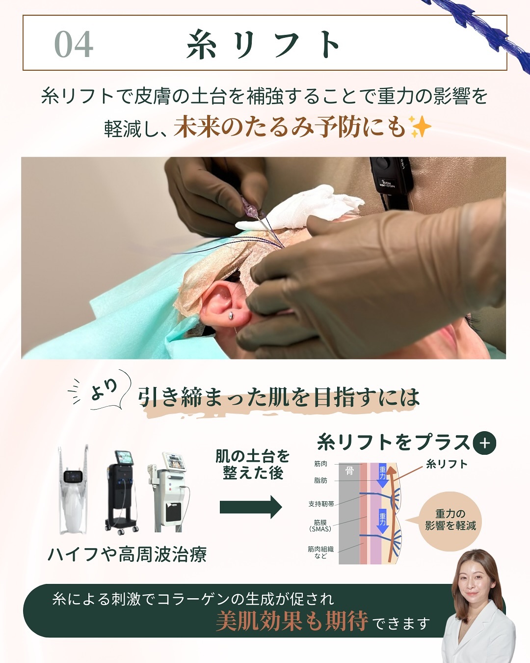 Thread Lift