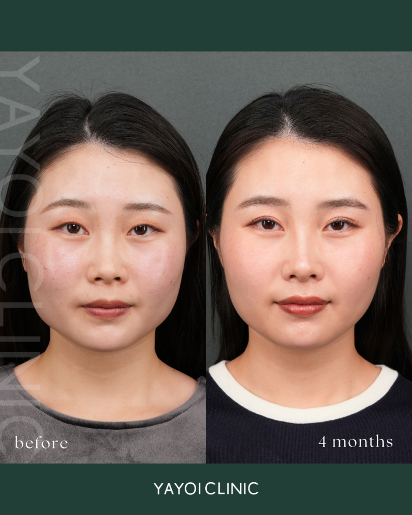 Cosmetic Surgery Double Implantation Natural Adhesion Method