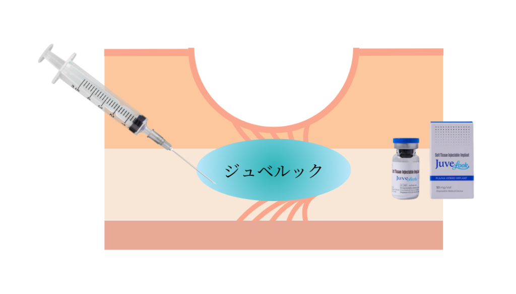 ジュベルックを広島で受けるなら｜特徴や施術の流れを解説