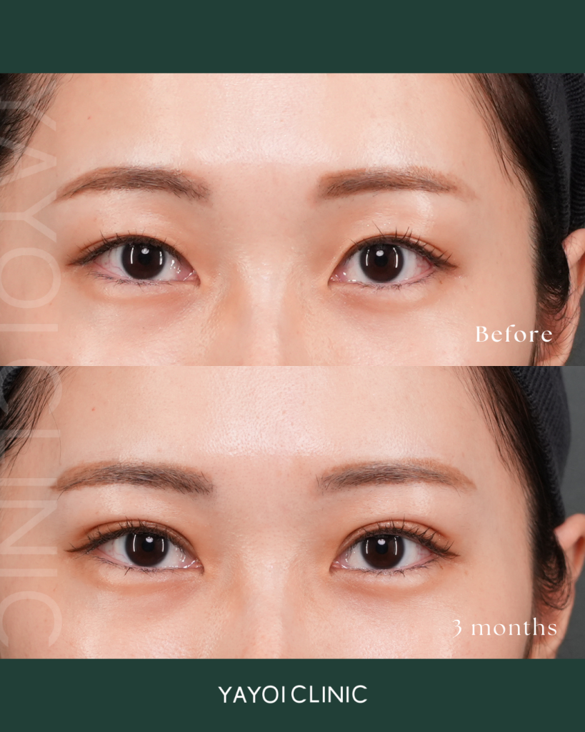 Cosmetic Surgery Double Implantation Natural Adhesion Method