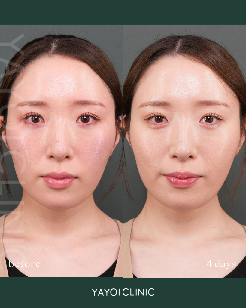 Customized hyaluronic acid injection (tear troughs)