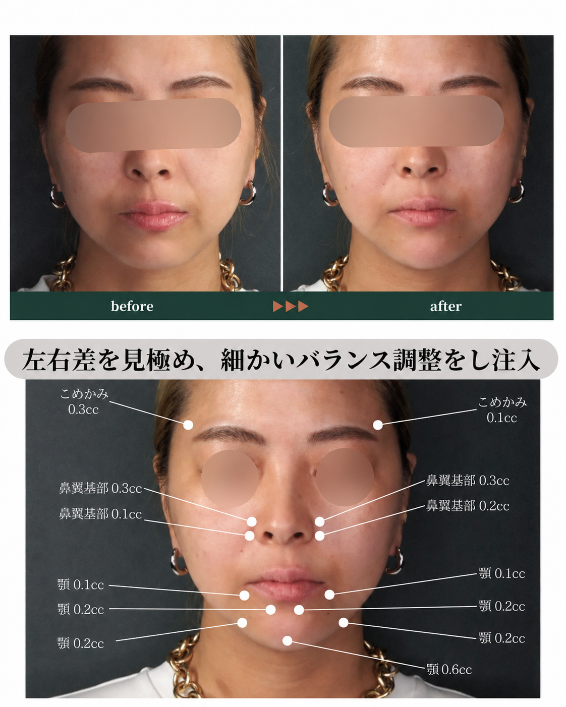 ヒアルロン酸注入左右のバランス調整
