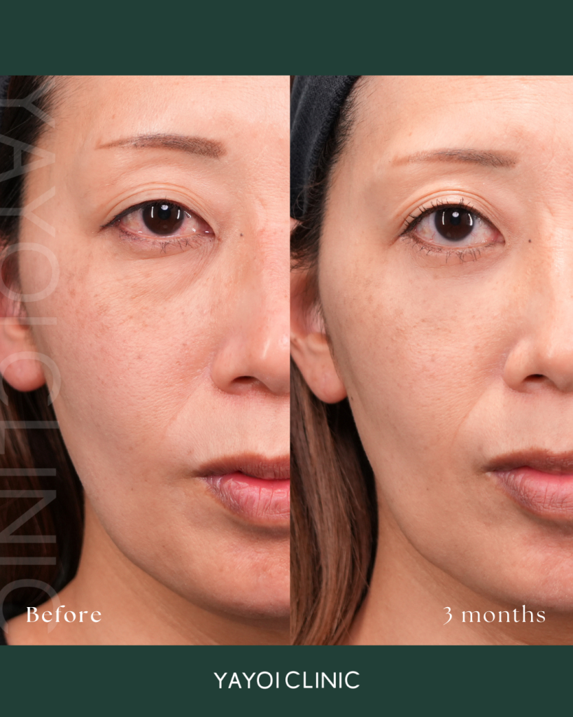 Sagging Under the Eyes and Dark Circles: The Omote-Hamura Method
