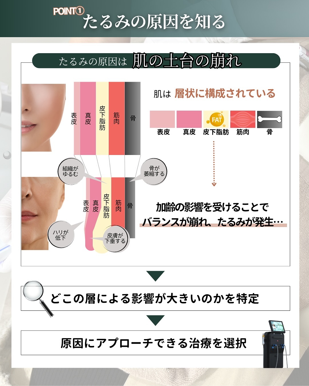 たるみ　原因