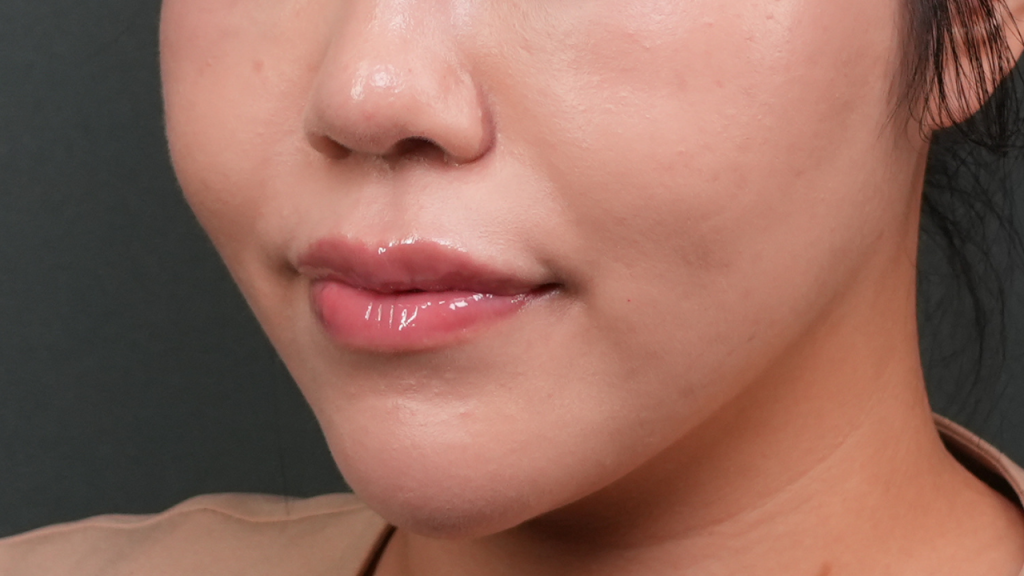 Lip hyaluronic acid