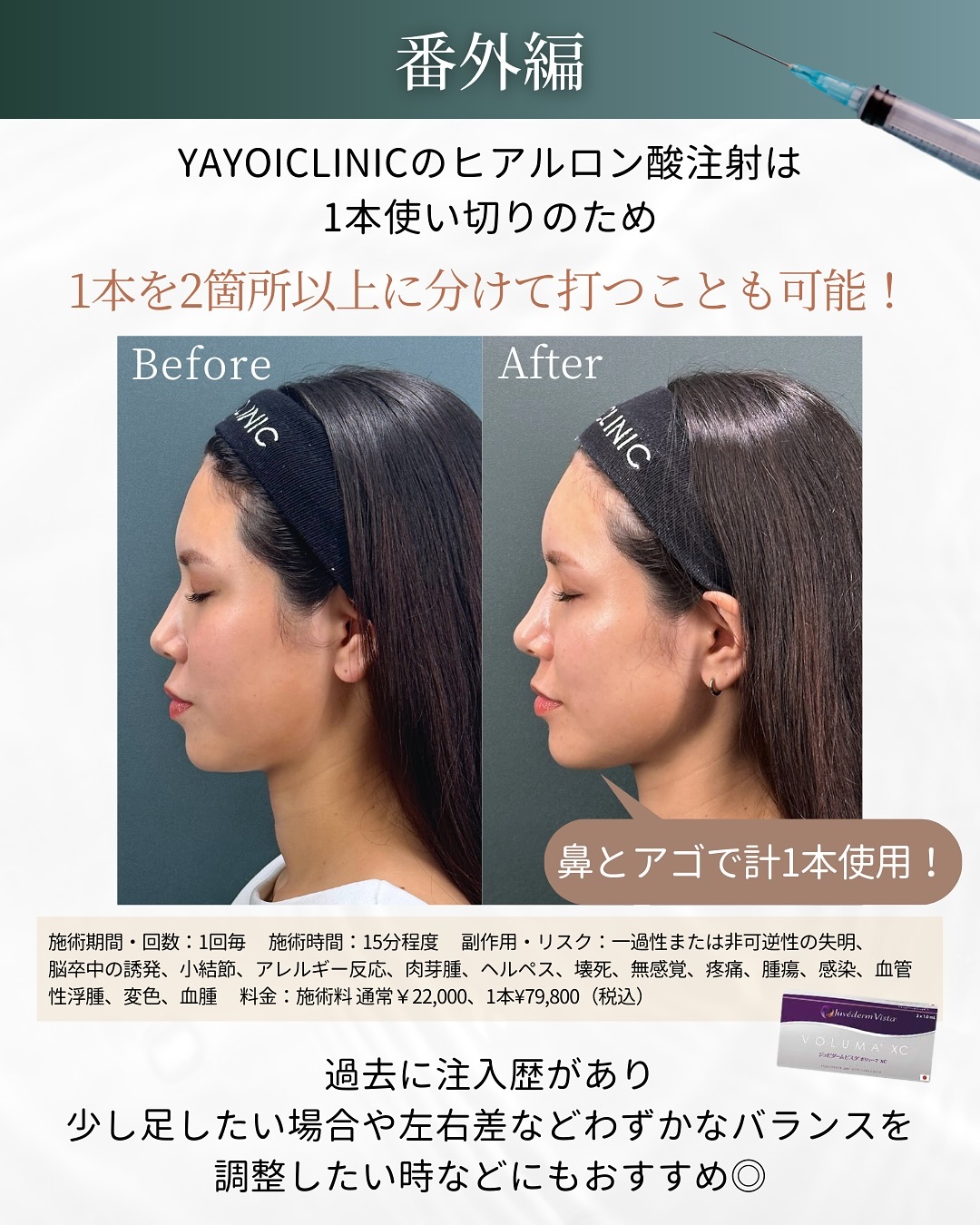 Hyaluronic Acid Injection at Yayoi Clinic