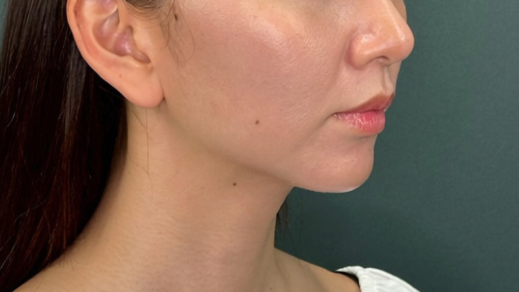 Hyaluronic Acid Injections for the Jawline