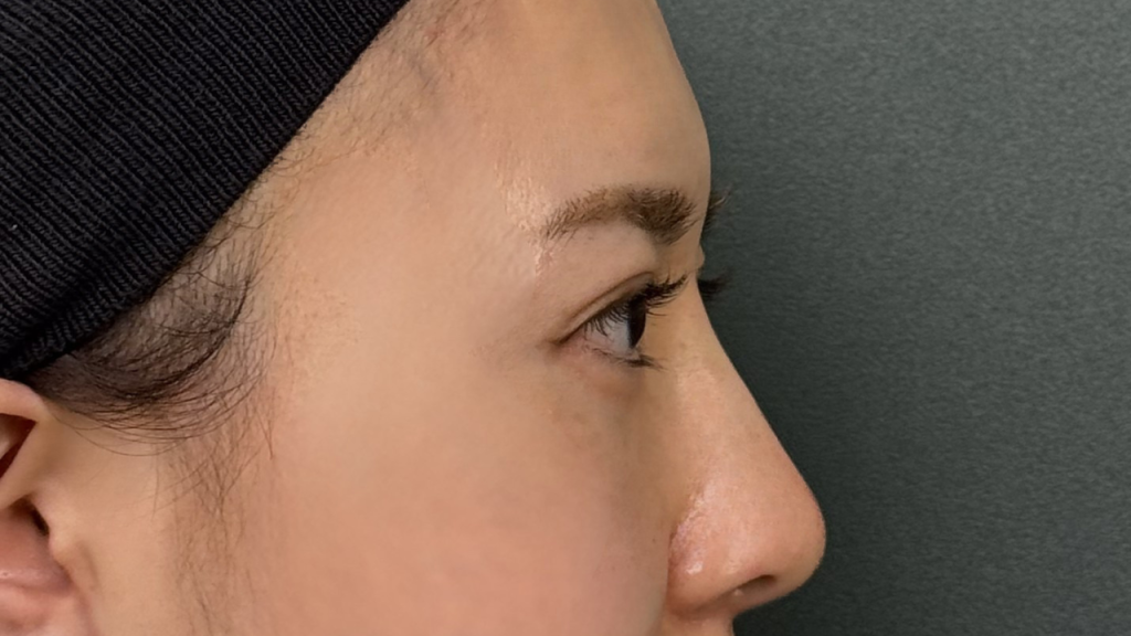 Hyaluronic Acid Injections for the Nose