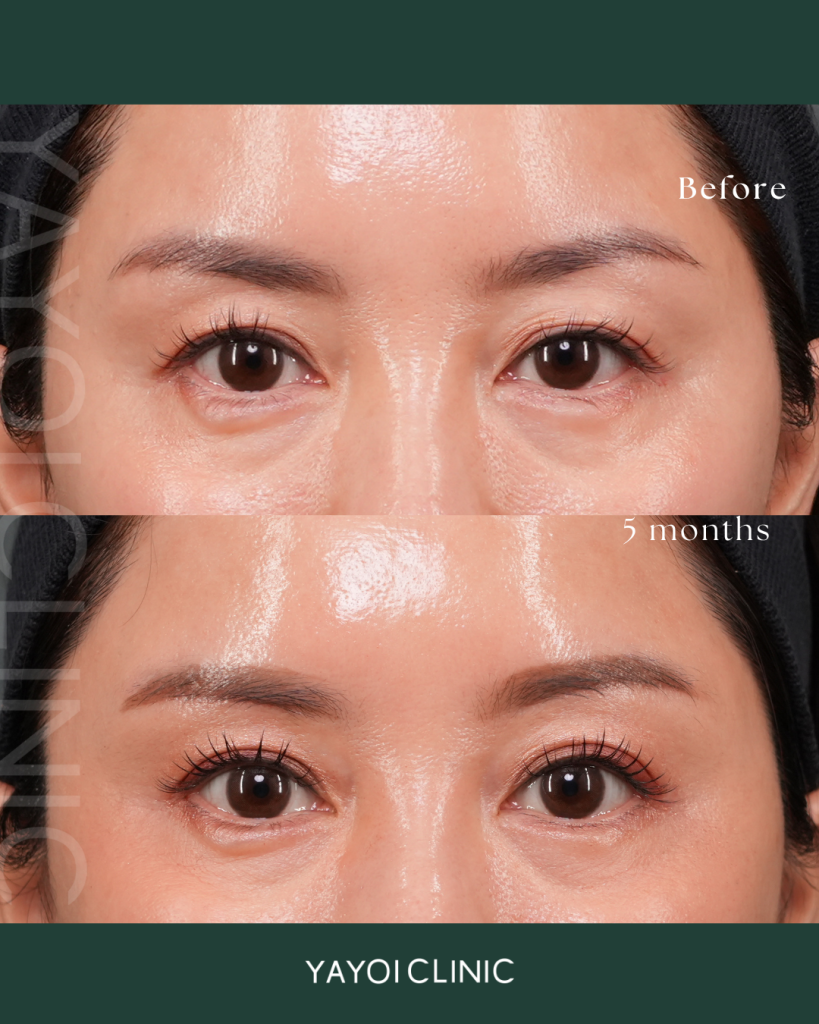 Cosmetic Surgery Sagging eyelids Lift under the eyebrow (subglabellar incision)