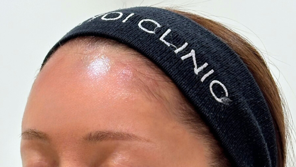 Hyaluronic Acid Injections for the Forehead