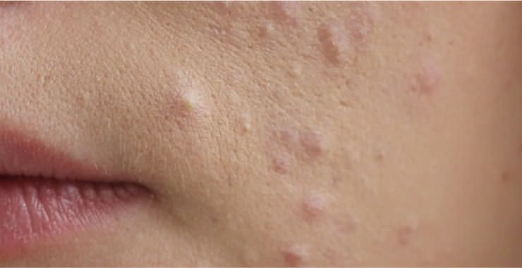 Acne Treatment in Hiroshima | What Are the Most Popular Treatments at Dermatology Clinics? From Types of Acne to Treatment Features