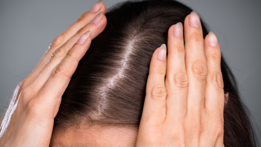 Thinning Hair