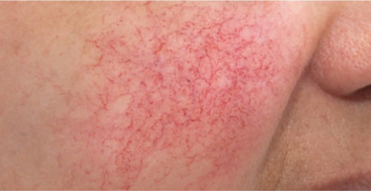 Want to Treat Facial Redness at a Cosmetic Dermatology Clinic in Naka Ward, Hiroshima City? Here Are the Causes and Treatment Options